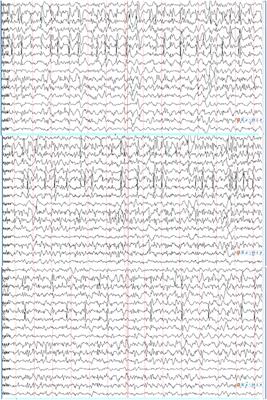 Differential Functional Changes of Nav1.2 Channel Causing SCN2A-Related Epilepsy and Status Epilepticus During Slow Sleep